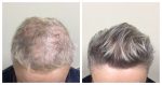 Tempus Hair Restoration Dr. Barusco